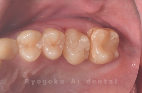 自家歯牙移植術治療完了