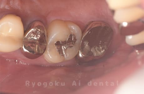 重度カリエス１