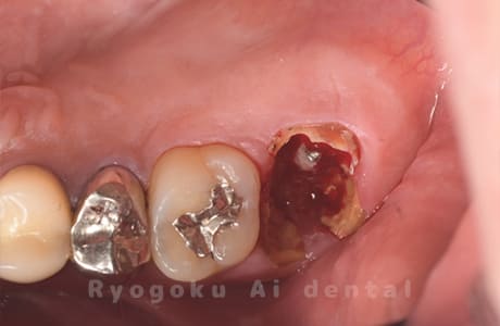 重度カリエス２