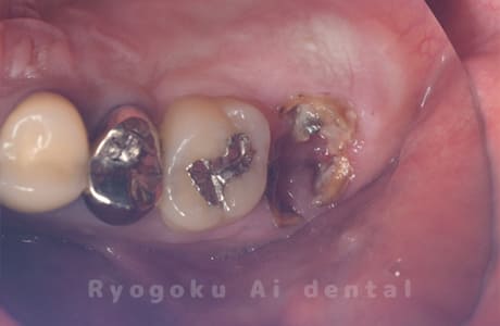 重度カリエス３