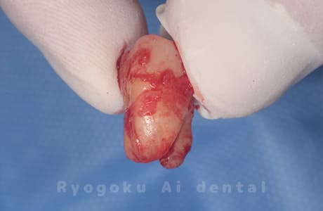 移植する親知らず