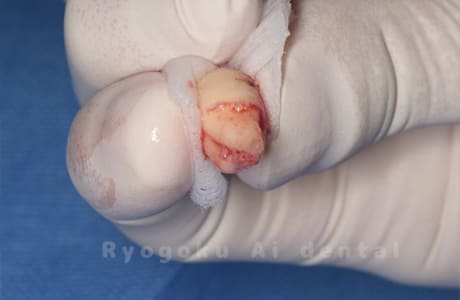 自家歯牙移植の親知らず