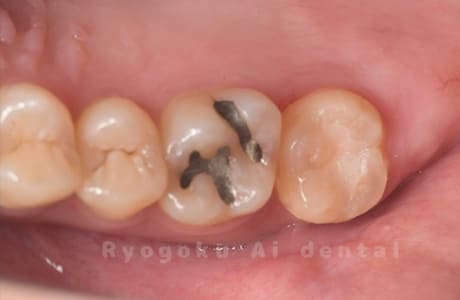 自家歯牙移植術後