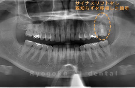 自家歯牙移植レントゲン