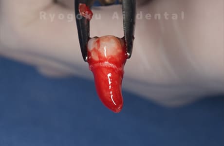 自家歯牙移植の親知らず