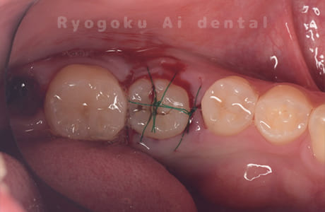 自家歯牙移植術後