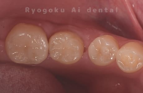 自家歯牙移植術治療完了