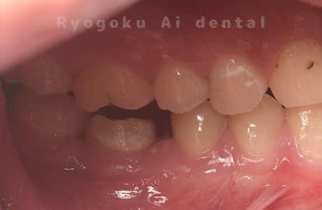 自家歯牙移植術後