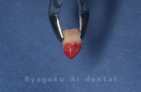 自家歯牙移植の親知らず