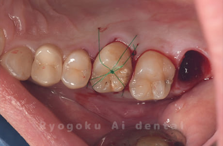 自家歯牙移植術後