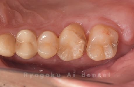 自家歯牙移植術治療完了