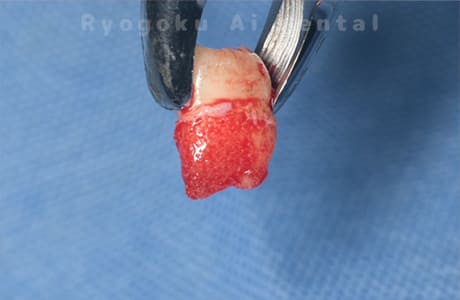 自家歯牙移植の親知らず