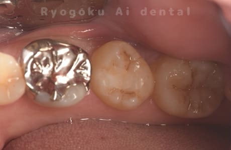 自家歯牙移植術後