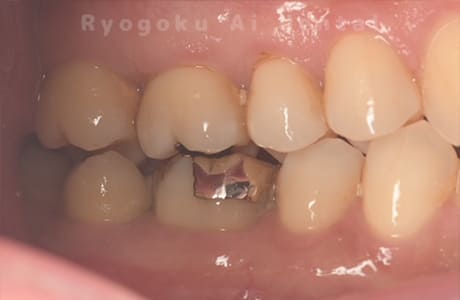 自家歯牙移植術治療完了