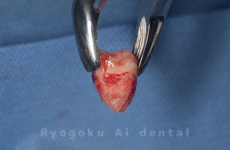 自家歯牙移植の親知らず