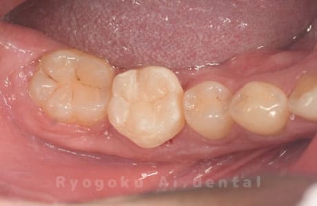 自家歯牙移植術治療完了