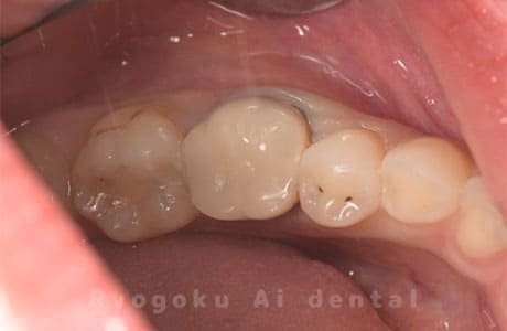 クラウン重度二次カリエス
