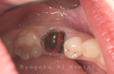 自家歯牙移植の親知らず