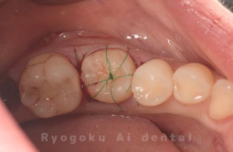自家歯牙移植術後