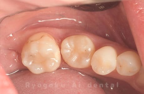 自家歯牙移植術治療完了