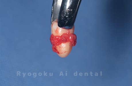 自家歯牙移植の親知らず