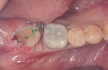 自家歯牙移植術後