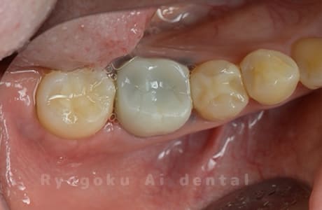 自家歯牙移植術治療完了