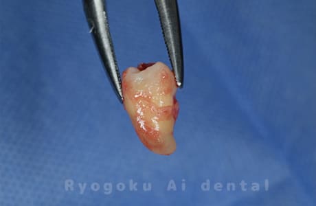 自家歯牙移植の親知らず