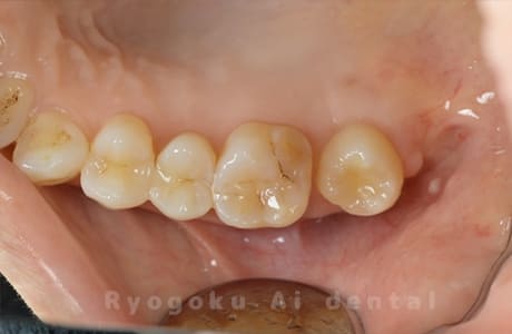 自家歯牙移植術治療完了