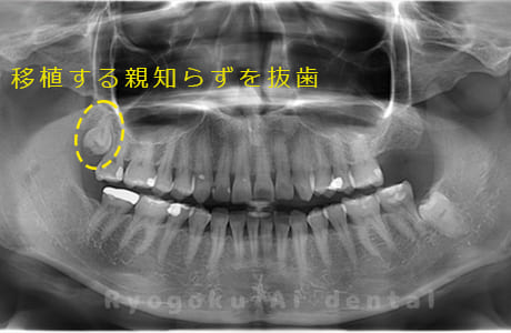 移植する親知らずレントゲン