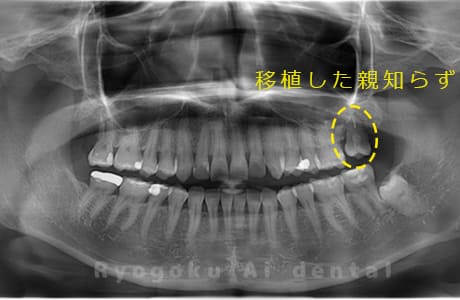移植した親知らずレントゲン