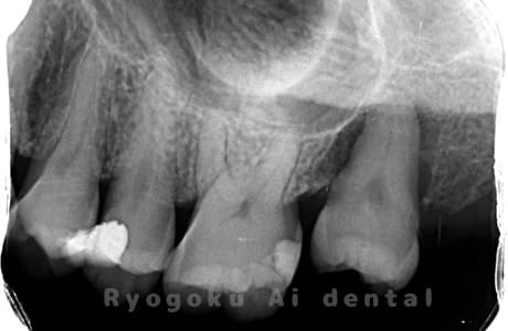 自家歯牙移植の親知らず