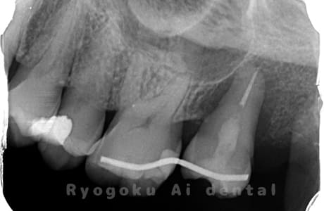 自家歯牙移植術後