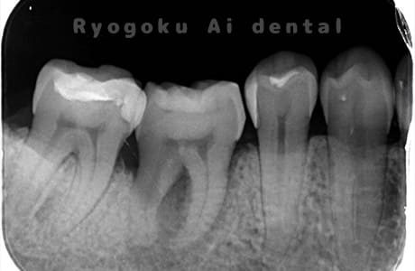自家歯牙移植術後
