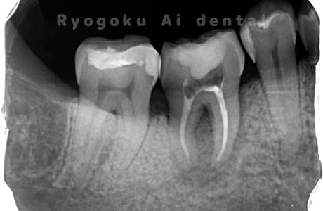 自家歯牙移植術治療完了