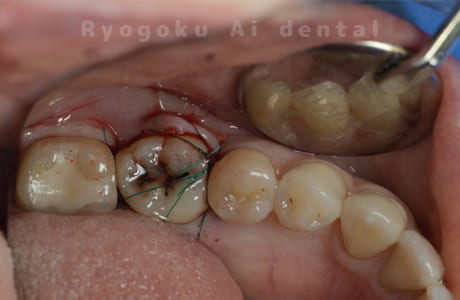 自家歯牙移植術後