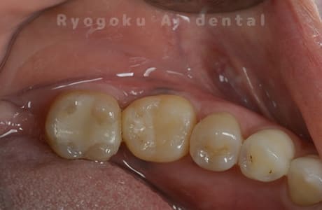 自家歯牙移植術治療完了