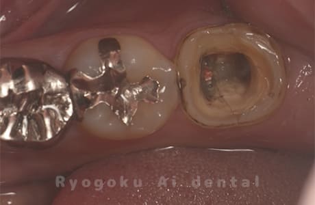 右下7番歯根破折