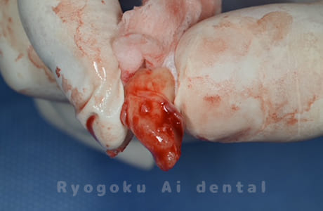 自家歯牙移植の親知らず