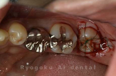 自家歯牙移植術後