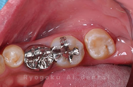 自家歯牙移植術治療完了