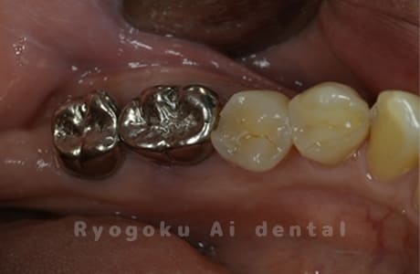 左下の奥歯の歯根破折