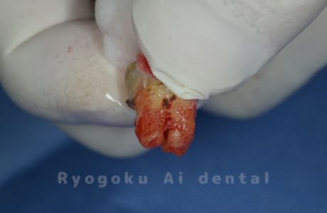 自家歯牙移植の親知らず
