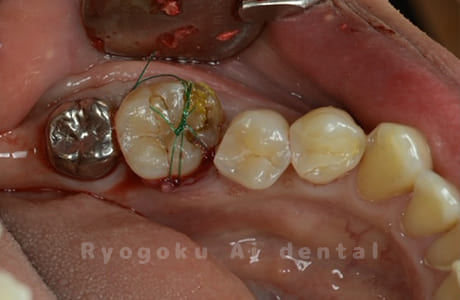 自家歯牙移植術後