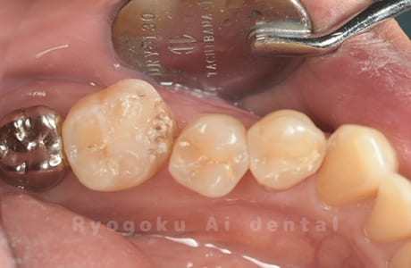 自家歯牙移植術治療完了咬合面