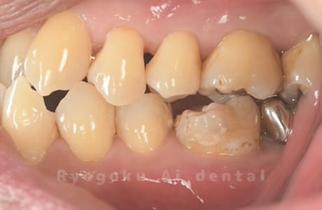 自家歯牙移植術治療完了側面