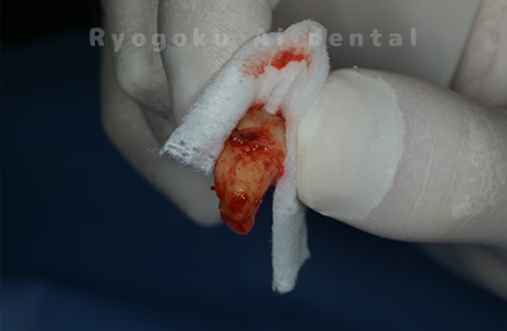 自家歯牙移植の親知らず