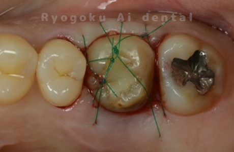 自家歯牙移植術後