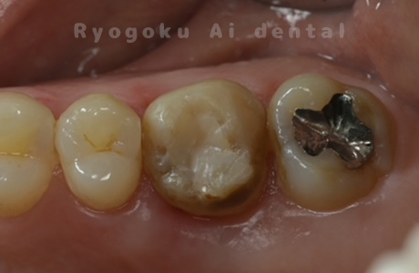 自家歯牙移植術治療完了