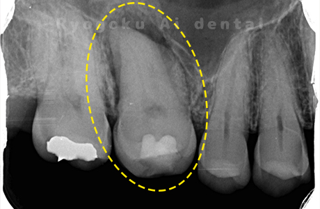 左上歯牙欠損レントゲン